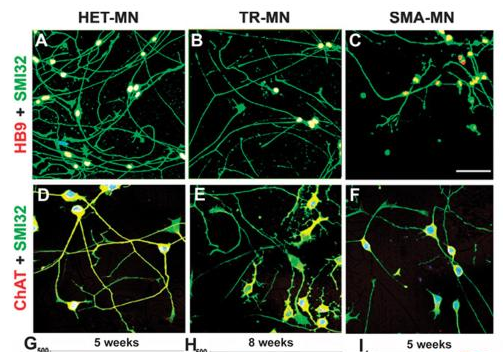 2012年干細胞治療脊髓性肌萎縮癥臨床案例 2012年干細胞治療脊髓性肌萎縮癥臨床案例