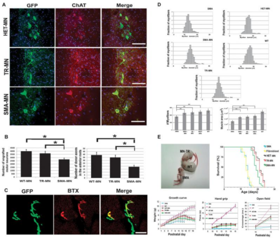2012年干細胞治療脊髓性肌萎縮癥臨床案例 2012年干細胞治療脊髓性肌萎縮癥臨床案例