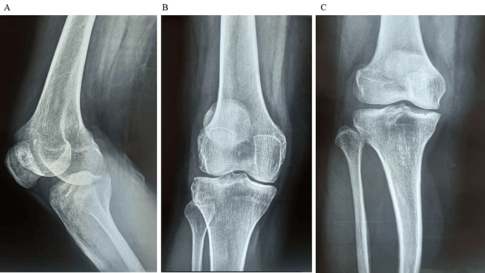 圖1：顯示了開始干細胞治療之前的骨骼側(cè)視圖和前后視圖。