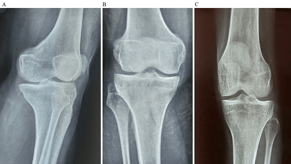 圖2：顯示了開始干細胞治療后骨骼的側(cè)視圖和前后視圖