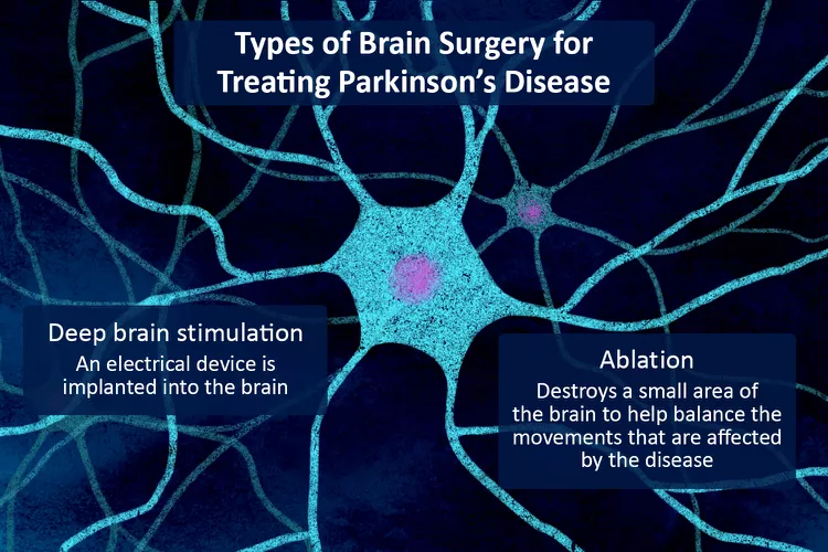 帕金森病的腦部手術：類型、恢復和風險