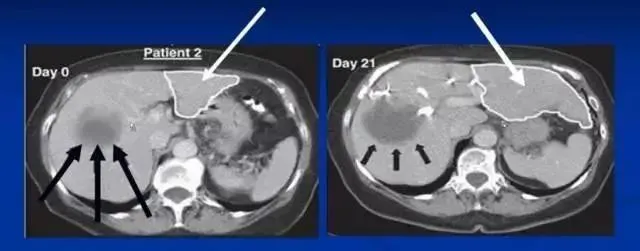 干細胞治療肝硬化的治療效果如何? 干細胞治療肝硬化的治療效果如何?