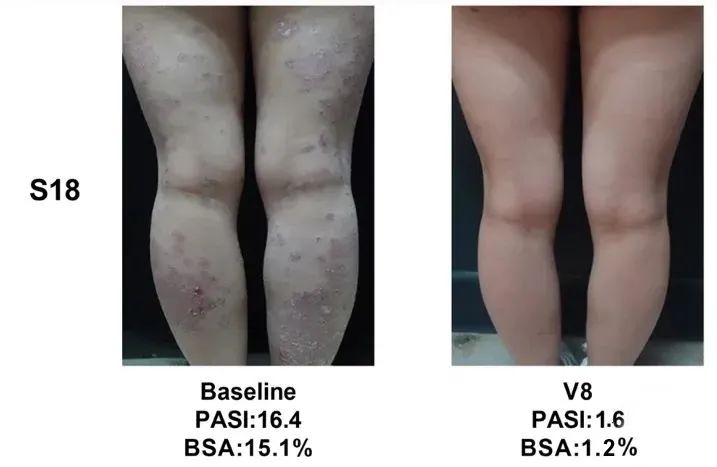 總共47.1% (8/17)的銀屑病患者在PASI(皮損面積和嚴(yán)重程度)評(píng)分中有至少40%的改善 總共47.1% (8/17)的銀屑病患者在PASI(皮損面積和嚴(yán)重程度)評(píng)分中有至少40%的改善