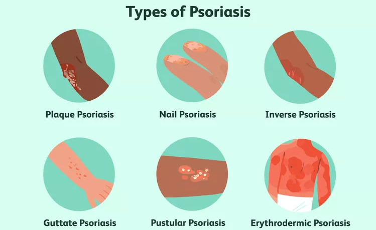 盤點(diǎn)國(guó)內(nèi)各大醫(yī)院運(yùn)用干細(xì)胞治療銀屑病的臨床應(yīng)用 盤點(diǎn)國(guó)內(nèi)各大醫(yī)院運(yùn)用干細(xì)胞治療銀屑病的臨床應(yīng)用