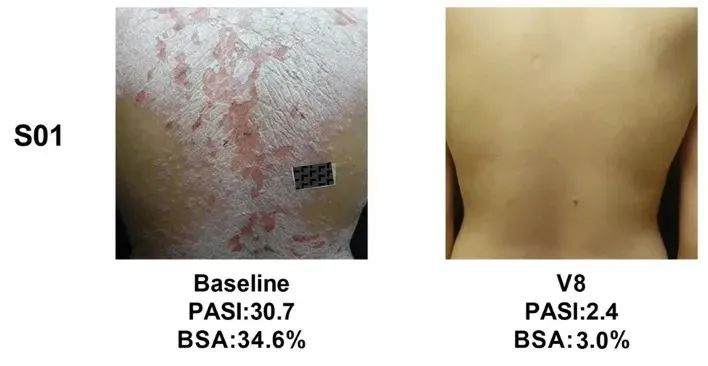 同種異體UMSCs的移植對(duì)銀屑病患者安全且部分有效,尤其對(duì)女性銀屑病患者 同種異體UMSCs的移植對(duì)銀屑病患者安全且部分有效,尤其對(duì)女性銀屑病患者