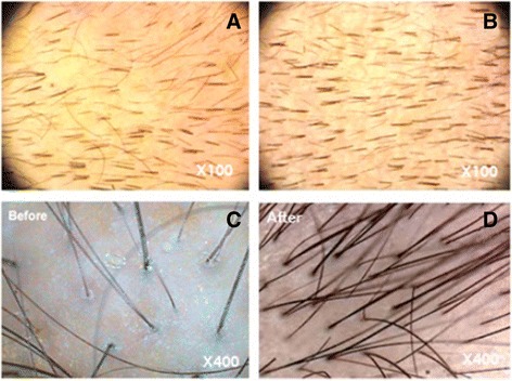 圖3：記錄脂肪干細胞療法后頭發數量增加的照片。移植前（ac）和移植后6個月（bd）頭皮的代表性圖像