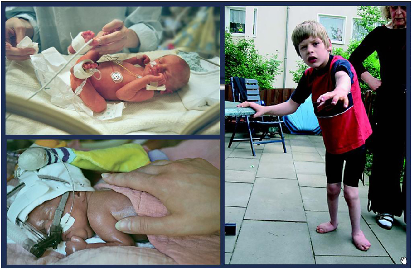 腦癱 (CP) 是兒童期最常見的殘疾,是一種嚴重的非進行性嬰幼兒腦部疾病,具有終身后遺癥 腦癱 (CP) 是兒童期最常見的殘疾,是一種嚴重的非進行性嬰幼兒腦部疾病,具有終身后遺癥