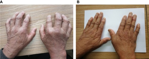 (圖1A)表現為雙手不能伸直。 (圖1B)治療3年后,停用抗風濕藥物5年,雙手伸展自如,關節周圍風濕結節逐漸變軟、消退。 (圖1A)表現為雙手不能伸直。
(圖1B)治療3年后,停用抗風濕藥物5年,雙手伸展自如,關節周圍風濕結節逐漸變軟、消退。