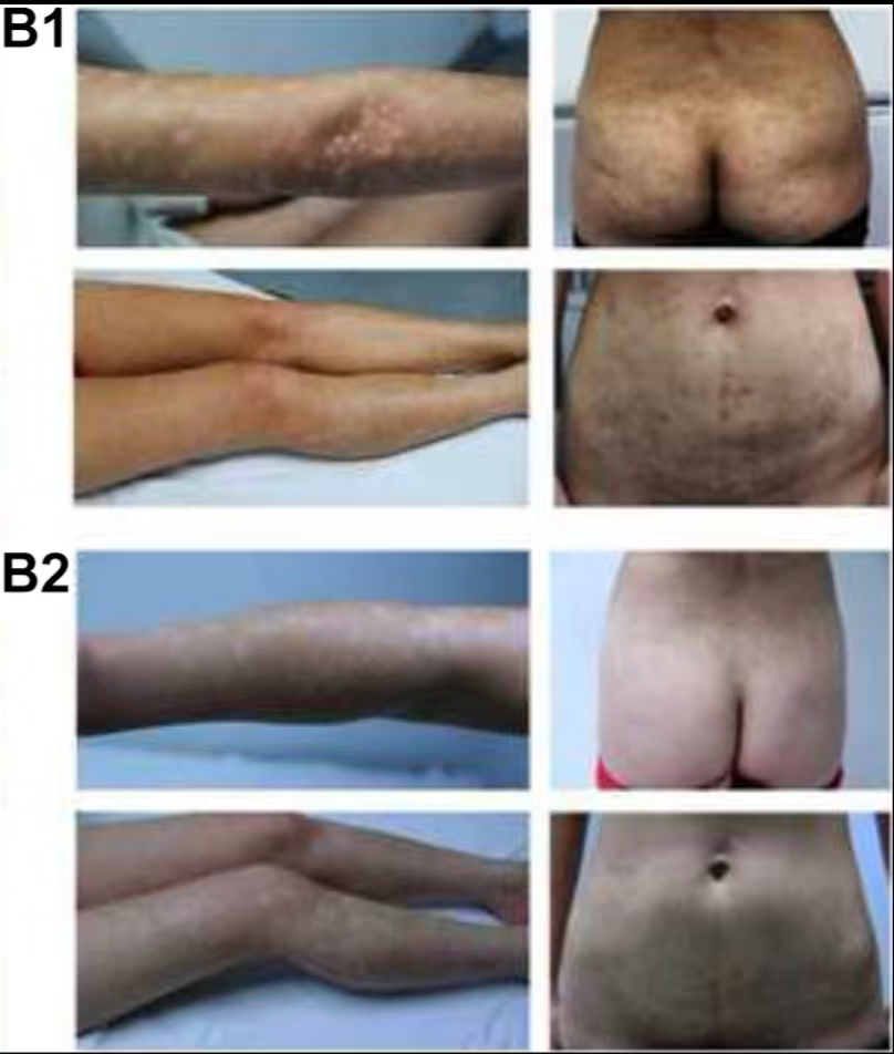 (圖B1)患者入院后體檢發(fā)現(xiàn),患者全身遍布橙紅色斑塊,上面覆有銀色鱗屑 (圖B2)治療初期,我院給予患者3次臍帶間充質(zhì)干細(xì)胞(每次1×10?6?/Kg),連續(xù)3周回輸,患者全身表面逐漸恢復(fù)光滑 (圖B1)患者入院后體檢發(fā)現(xiàn),患者全身遍布橙紅色斑塊,上面覆有銀色鱗屑
(圖B2)治療初期,我院給予患者3次臍帶間充質(zhì)干細(xì)胞,連續(xù)3周回輸,患者全身表面逐漸恢復(fù)光滑