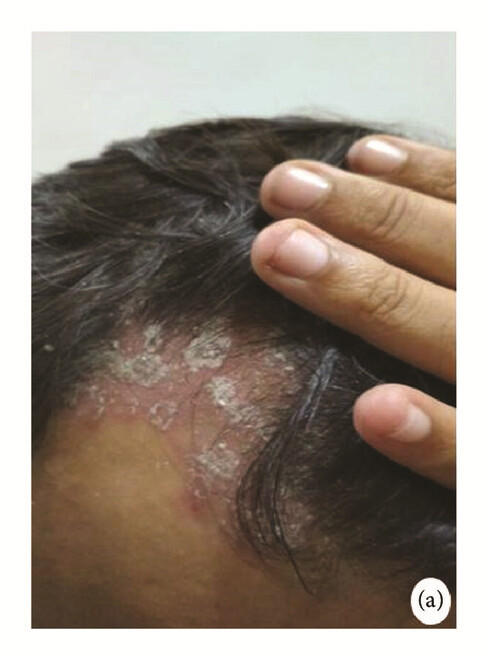 骨髓間充質(zhì)干細(xì)胞 治療前,患者頭皮上出現(xiàn)大量紅斑,并附著銀色鱗片(a)。 骨髓間充質(zhì)干細(xì)胞 治療前,患者頭皮上出現(xiàn)大量紅斑,并附著銀色鱗片(a)。
