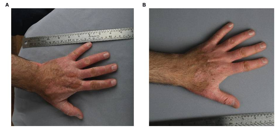 患者3細胞移植6個月后，注射部位的紅斑、脫屑和厚度明顯減少。皮膚厚度從2.1毫米減少到1.7毫米，與手部健康部位相似。該患者報告生活質量有所提高。PASI評分在注射細胞后從4.7變為4.3。