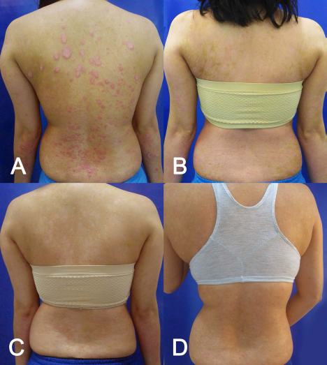 (圖2A）基線（細胞移植前)；(圖2B）首次輸注后 30 天；(圖C2) 121 天后；(圖2D）231 天后。