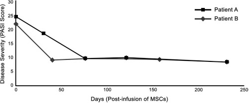 圖 1?. 移植 MSCs 前后兩例患者的銀屑病面積和嚴重程度指數 (PASI) 評分總結。在輸注 MSCs 后的隨訪中，每例患者的 PASI 評分均有所下降。評分由第三方皮膚科醫生進行。臨床改善持久，患者 A 的改善持續超過 150 天，患者 B 的改善持續超過 200 天。