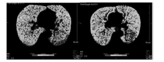 雙源CT肺實(shí)質(zhì)分析軟件 雙源CT肺實(shí)質(zhì)分析軟件