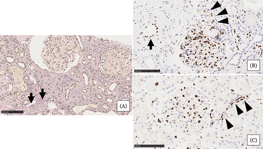 圖1：住院第 31 天的腎臟活檢結(jié)果。