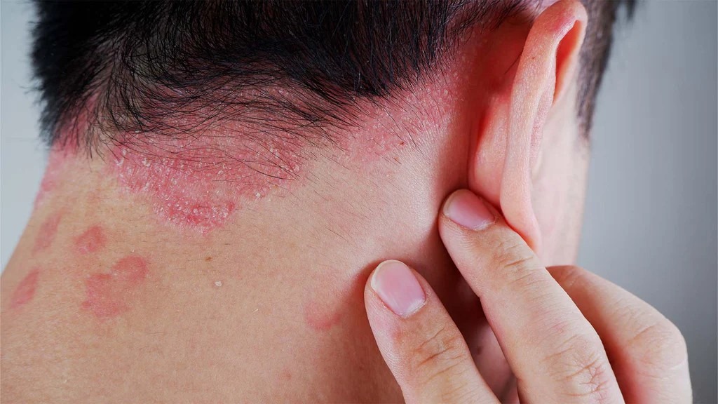 銀屑病如何治療？干細胞療法如何為銀屑病患者掃除障礙？