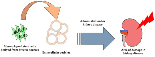 干細胞治療腎病 干細胞治療腎病
