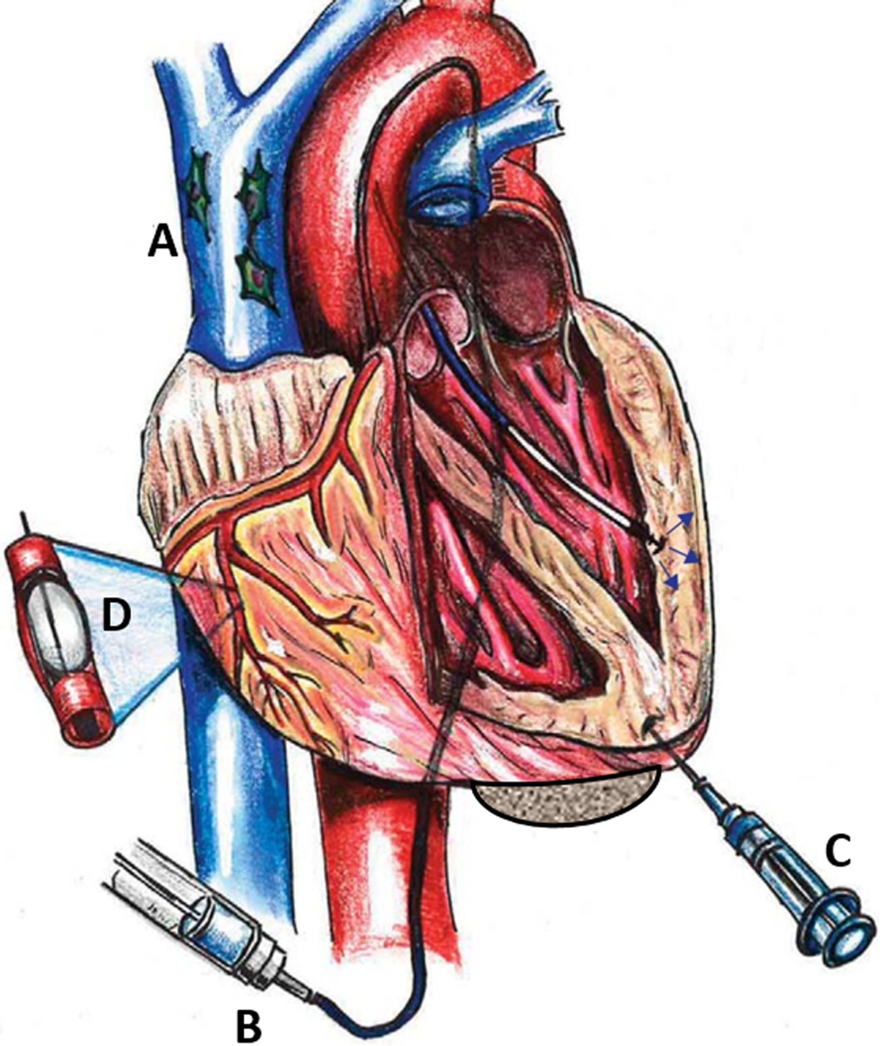 圖1:MSC通過系統 (Sys) 和局部 (Loc) 途徑進入心臟。