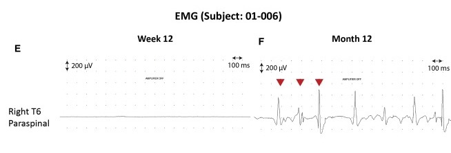 圖3：患者2腦運(yùn)動控制評估(BMCA)和EMG評估