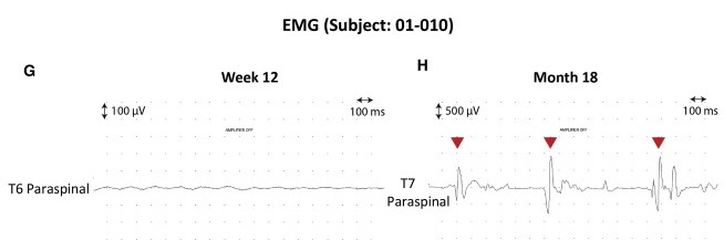 圖4：患者4腦運(yùn)動控制評估(BMCA)和EMG評估