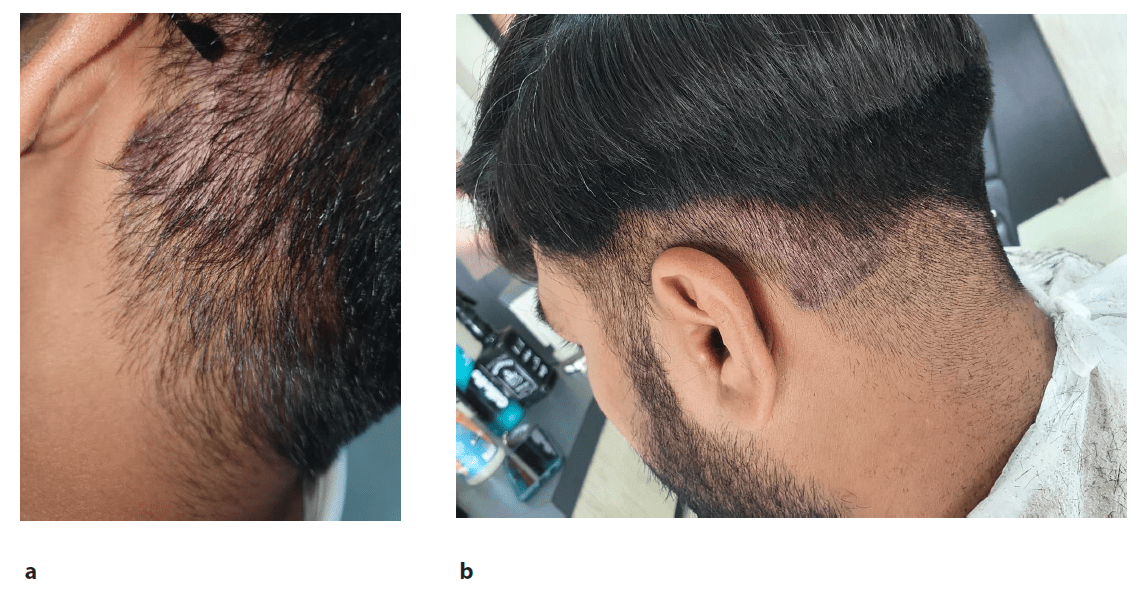 圖2:患者頸部枕部下方頭皮牛皮癬治療后圖像,治療后2周(a)和4周(b)隨訪時(shí)頭皮牛皮癬銀色鱗片和斑塊減少 圖2:患者頸部枕部下方頭皮牛皮癬治療后圖像,治療后2周(a)和4周(b)隨訪時(shí)頭皮牛皮癬銀色鱗片和斑塊減少