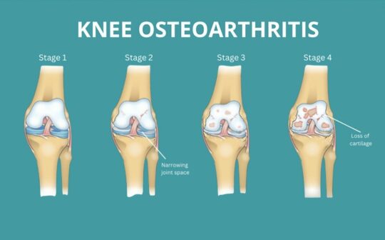 干細胞治療膝骨關節炎:患者臨床癥狀顯著改善,減少炎癥,消除疼痛 干細胞治療膝骨關節炎:患者臨床癥狀顯著改善,減少炎癥,消除疼痛