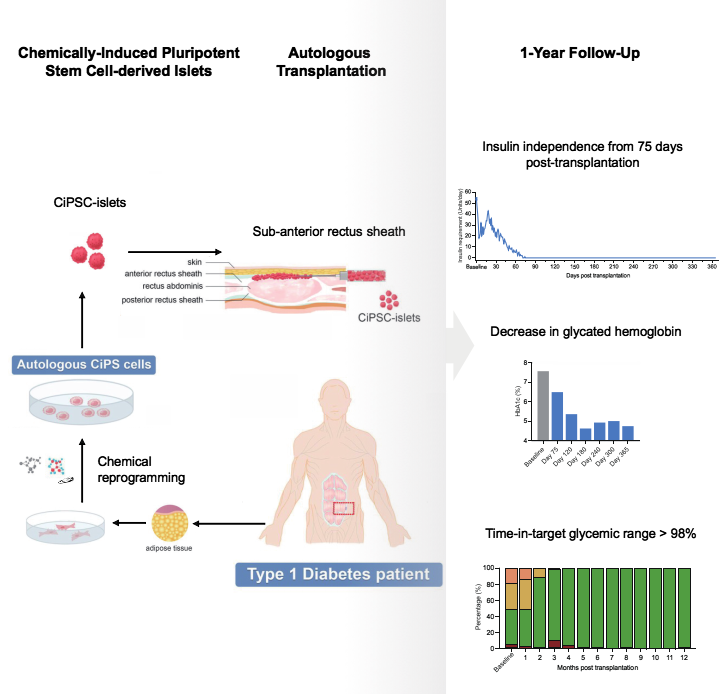 圖2:SLE患者接受CAR-T細胞治療的程序和結果。 圖2:SLE患者接受CAR-T細胞治療的程序和結果。