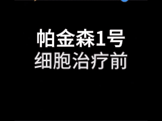 干細胞治療帕金森患者 干細胞治療帕金森患者