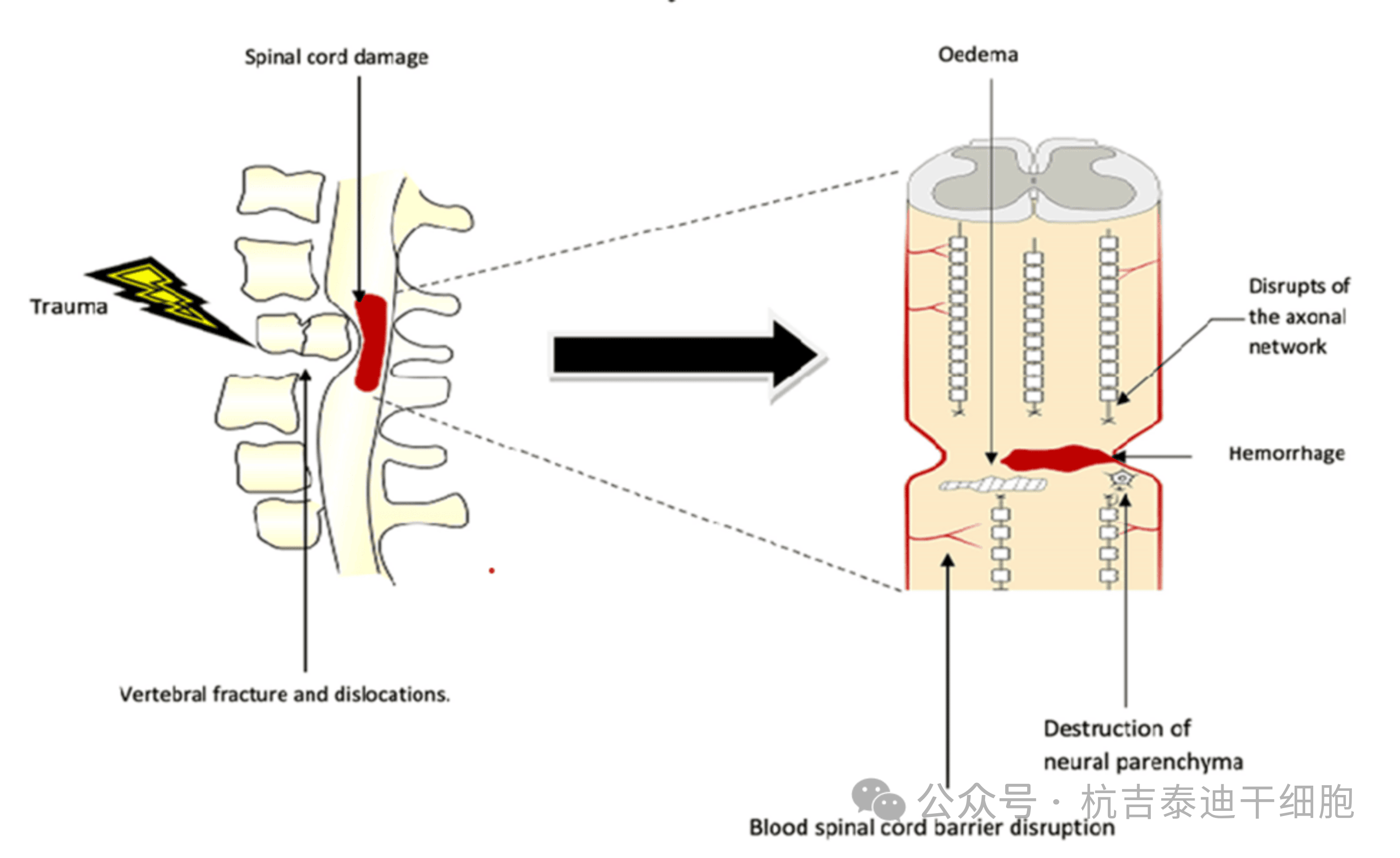 圖1：原發(fā)性病變，該圖顯示了創(chuàng)傷的直接影響，包括椎骨骨折、脫位和脊髓損傷導(dǎo)致軸突斷裂、水腫、出血和神經(jīng)實(shí)質(zhì)破壞