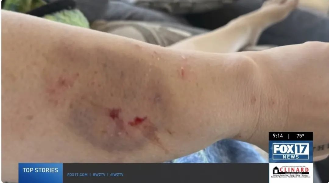 在接受干細胞治療前表現(xiàn)出嚴重的自閉癥癥狀，甚至曾咬傷母親安吉拉，留下了永久的疤痕