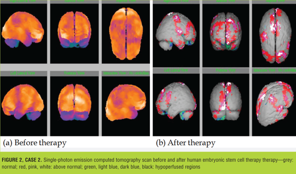 在大腦和小腦區(qū)域觀察到的灌注程度顯著降低（圖 2）