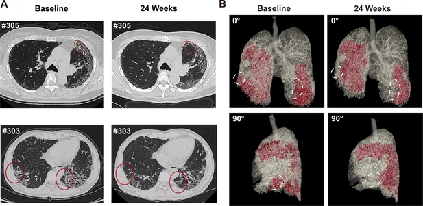 圖4：REGEND001治療前后的代表性肺部CT圖像。