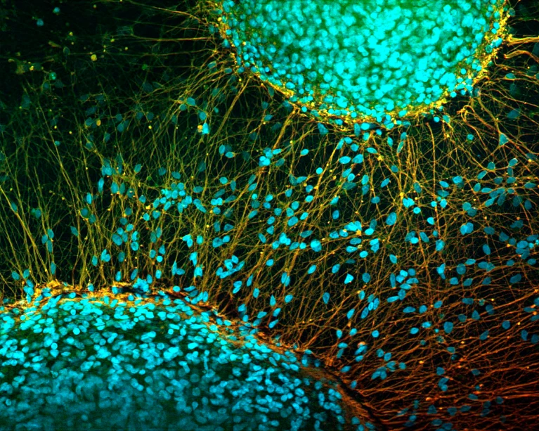 源自誘導(dǎo)性多能干細(xì)胞的神經(jīng)細(xì)胞具有逆轉(zhuǎn)癱瘓的潛力。