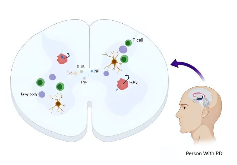 圖1：帕金森病的病理特征和神經炎癥的作用