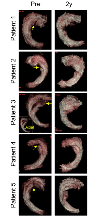 移植滑膜間充質干細胞修復前后的3D MRI圖像 移植滑膜間充質干細胞修復前后的3D MRI圖像