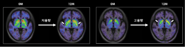 低劑量和高劑量TED-A9植入一年后的腦成像。
低劑量和高劑量TED-A9植入一年后的腦成像。