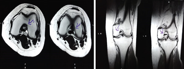治療后MRI檢查顯示內側和外側半月板后角撕裂有所改善 治療后MRI檢查顯示內側和外側半月板后角撕裂有所改善