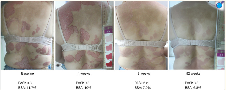 受試者治療前后的代表性皮膚圖像。