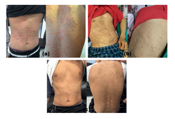 G-MSC 輸注對患有 5 年嚴重斑塊性銀屑病的 19 歲男性的影響。