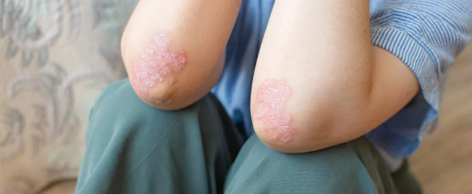 干細胞治療銀屑病：如何實現從短期銀屑病面積減少到長期皮膚恢復正常？