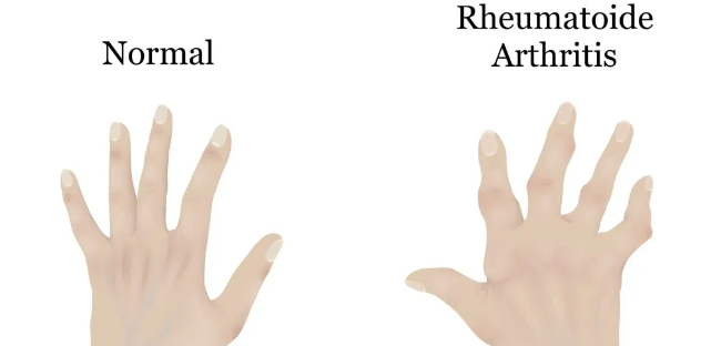 干細胞治療類風濕關節炎:如何實現從短期關節功能改善到長期的生活質量提升? 干細胞治療類風濕關節炎:如何實現從短期關節功能改善到長期的生活質量提升?