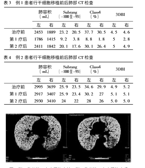 干細胞移植前后的肺部CT檢查對比 干細胞移植前后的肺部CT檢查對比