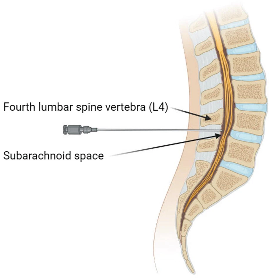 鞘內(nèi)細胞輸注 鞘內(nèi)細胞輸注