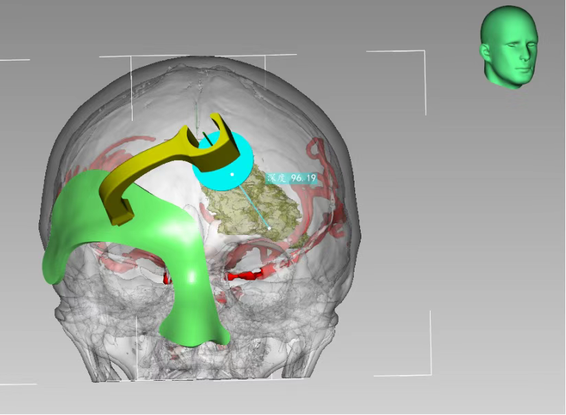 3D打印技術定位下腦內血腫穿刺術