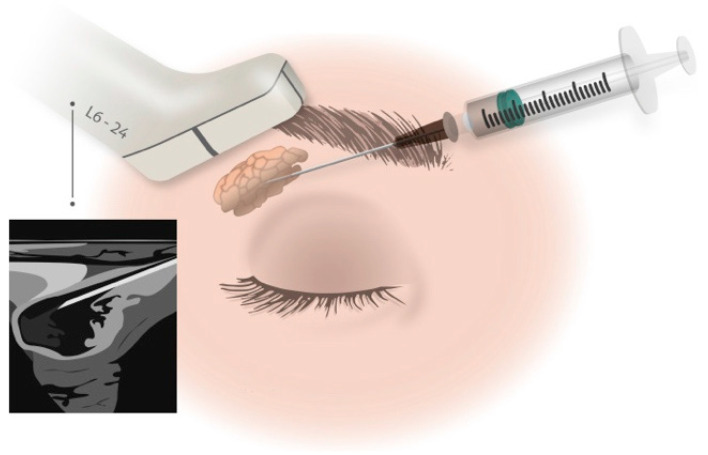圖1:在超聲引導(dǎo)下向淚腺注射藥物。 圖1:在超聲引導(dǎo)下向淚腺注射藥物。