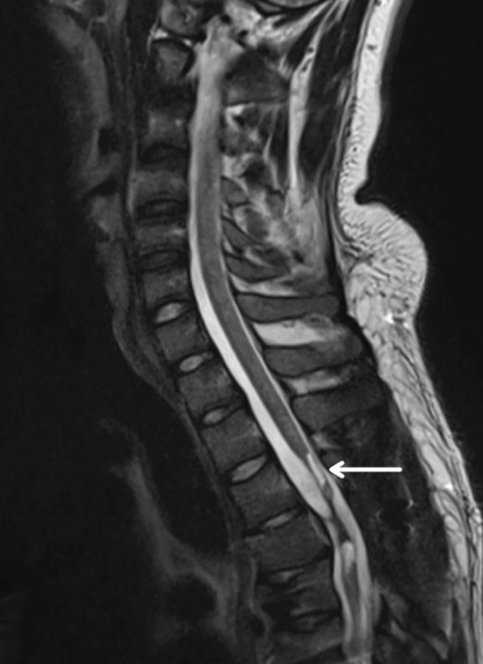 圖2：X射線圖像顯示慢性期脊髓損傷，通常以囊腫形成為特征，如白色箭頭所示