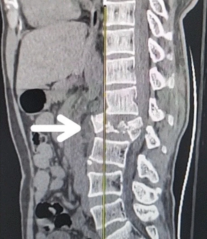 圖1：X射線圖像顯示脊髓損傷，椎骨骨折和移位，如白色箭頭所示