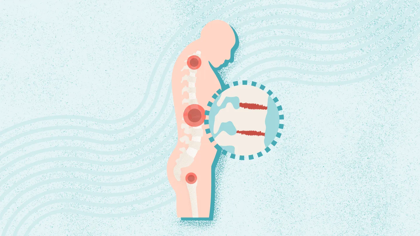 2025年干細胞治療強直性脊柱炎最新臨床進展(截至8月) 2025年干細胞治療強直性脊柱炎最新臨床進展(截至8月)