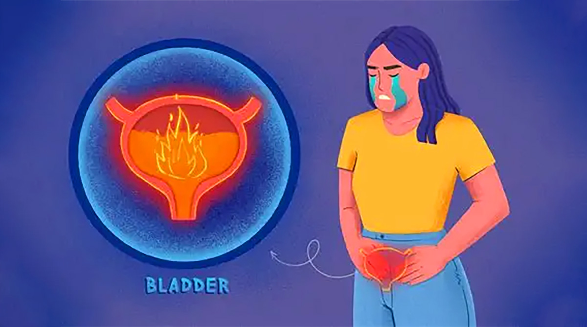 間質性膀胱炎 間質性膀胱炎