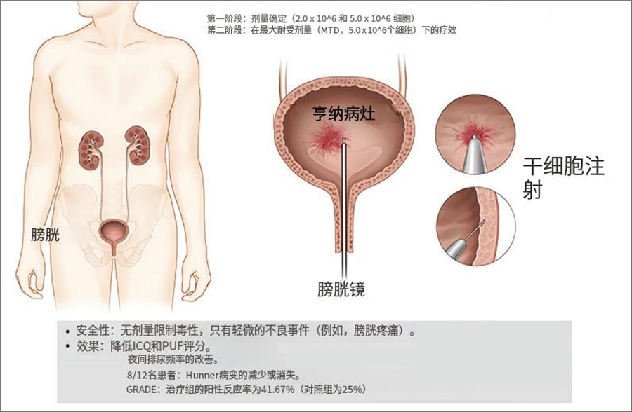干細胞治療 干細胞治療